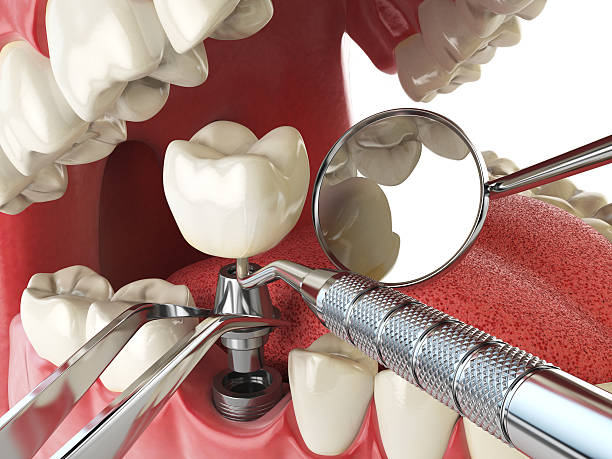 Best Lost Filling or Crown Replacement in Ebensburg, PA